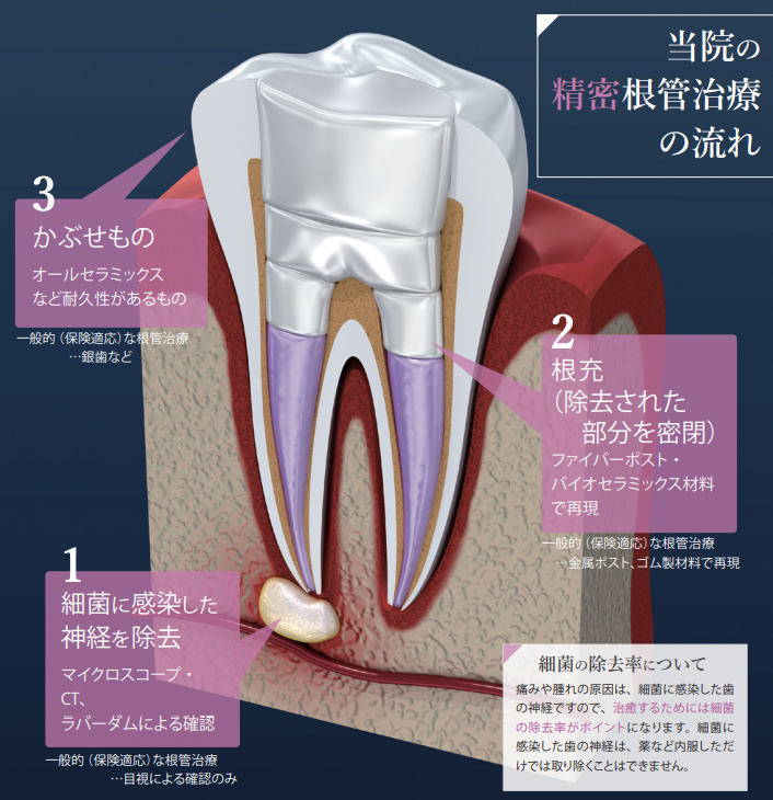 歯の根の専門治療