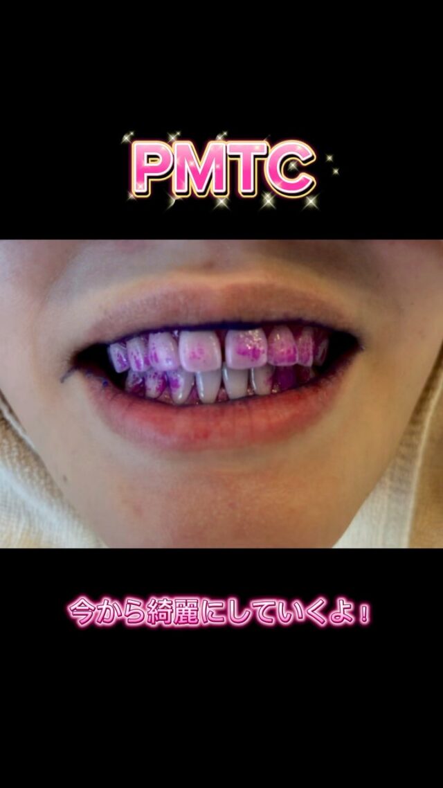 PMTCは歯の表面のバイオフィルム（細菌の膜）を全て除去してからトリートメント剤を塗り込むので、ツルッツルになります🥹💖

アイドルのような綺麗な歯にしてみませんか？✨

👉🏻平日（10:00〜16:00）¥6,600
  それ以外のお時間 ¥7,700

#一之江　#一之江駅　#江戸川区 #一之江駅前イルニード歯科 #歯科医院 #歯科 #歯科医師 #歯科衛生士 #歯科助手 #管理栄養士 #歯科衛生士の卵