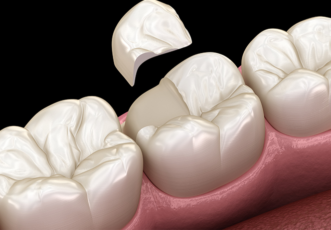 歯の根の専門治療