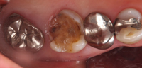 虫歯の症例
