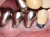 虫歯の症例2