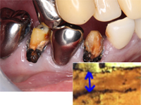 虫歯の症例2
