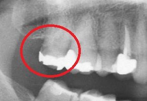 虫歯の症例3