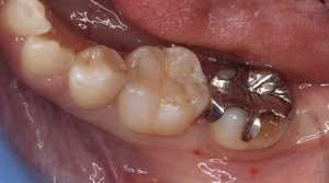 虫歯の症例4