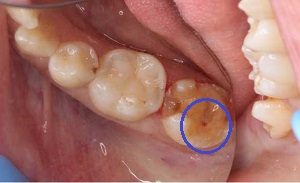 虫歯の症例4