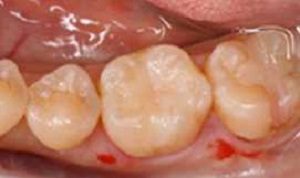 虫歯の症例5