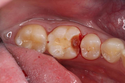 歯間の症例