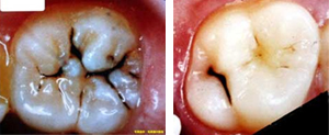 歯間の症例2