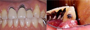 歯間の症例3