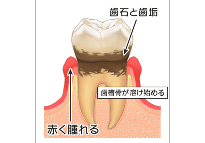 初期～軽度の歯周病