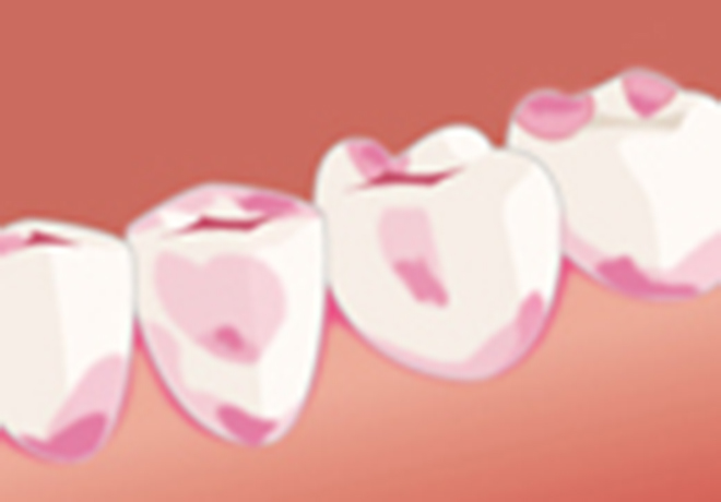 ブリッジ、クラウンなどの二次虫歯予防効果