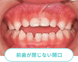 前歯が閉じない開口